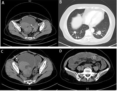 Case report: Rupture of an ileus tube in a patient with recurrent rectal cancer